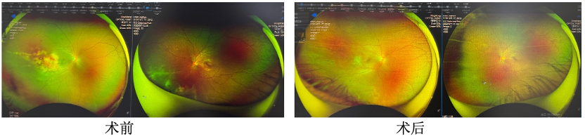 华西二院眼科成功救治移植术后巨细胞病毒性视网膜炎少年，拓展疑难眼底病诊疗能力